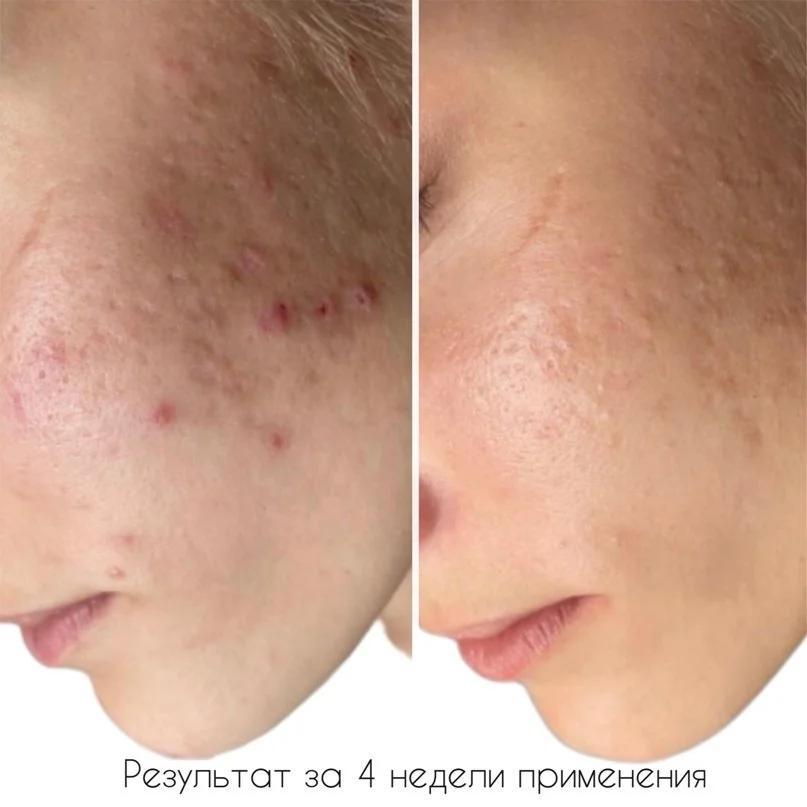 Крем ночной для ухода за проблемной кожей лица Ultraclear Night Cream