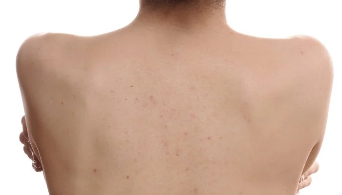 Акне на теле Kosmetika-proff.ru Акне на теле Kosmetika-proff.ru